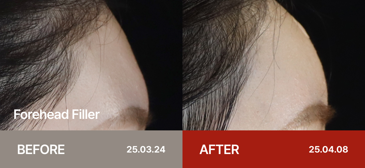 Ollium Forehead Filler before&after 2