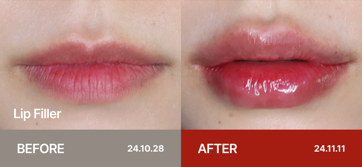 Ollium Lip Filler before&after 1