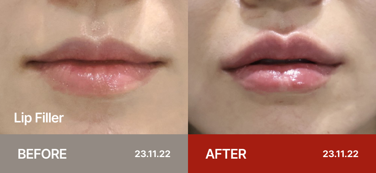 Ollium Lip Filler before&after 2