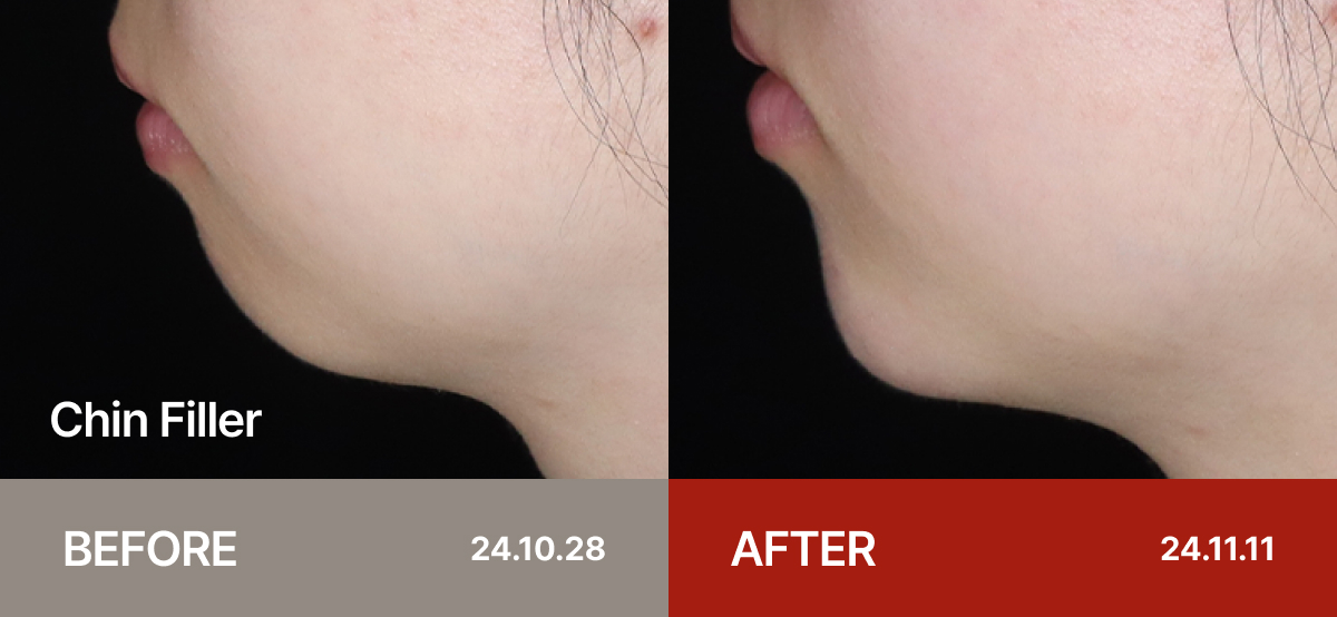 Ollium Chin Filler before&after 1