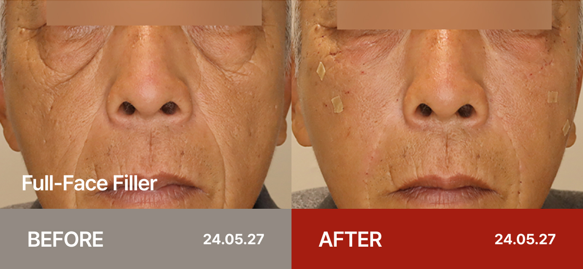 Ollium Full-Face Filler before&after 2